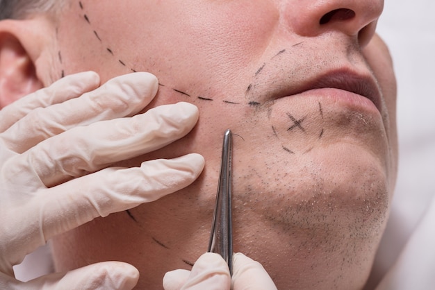 Beard Transplant