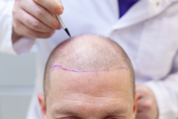 Advanced Hair Transplant Surgery